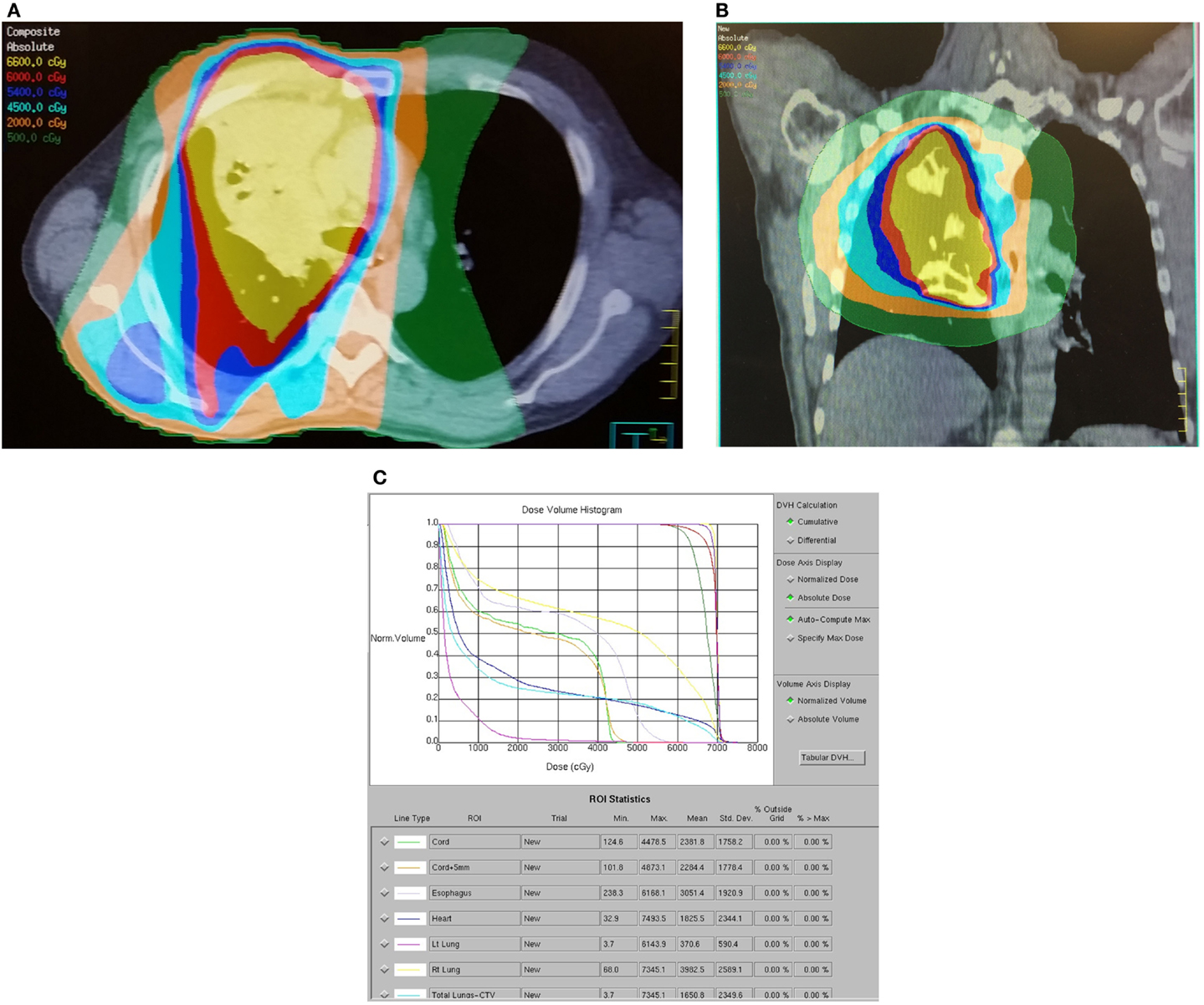 Dose volume histogram and isodose distribution showing esophageal sparing